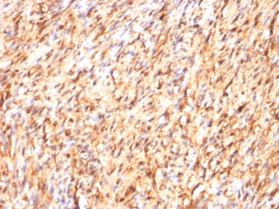 FFPE human schwanoma sections stained with 100 ul anti-S100B (clone S100B/1012) at 1:300. HIER epitope retrieval prior to staining was performed in 10mM Citrate, pH 6.0.